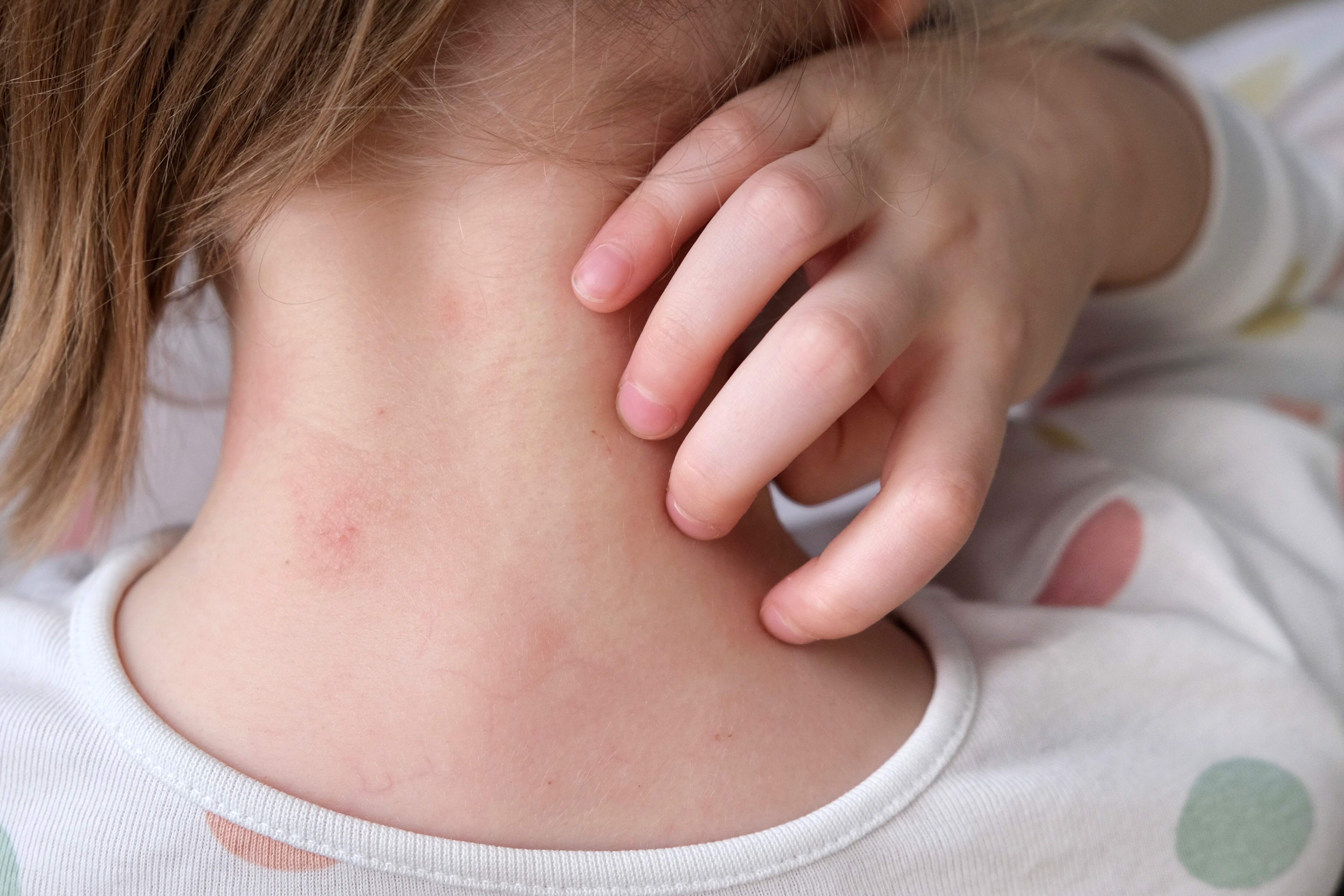 ALERJİK HASTALIKLAR (Atopik Dermatit, Astım, Gıda Alerjileri vb.)